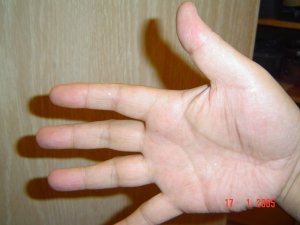 いぼが消失した。(2005年1月17日撮影)